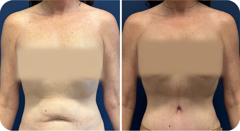 Before and after breast augmentation comparison with privacy protection markers