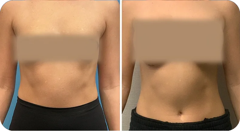 Before and after breast augmentation comparison with privacy protection markers