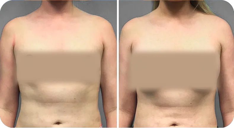 Before and after breast augmentation comparison with privacy protection markers