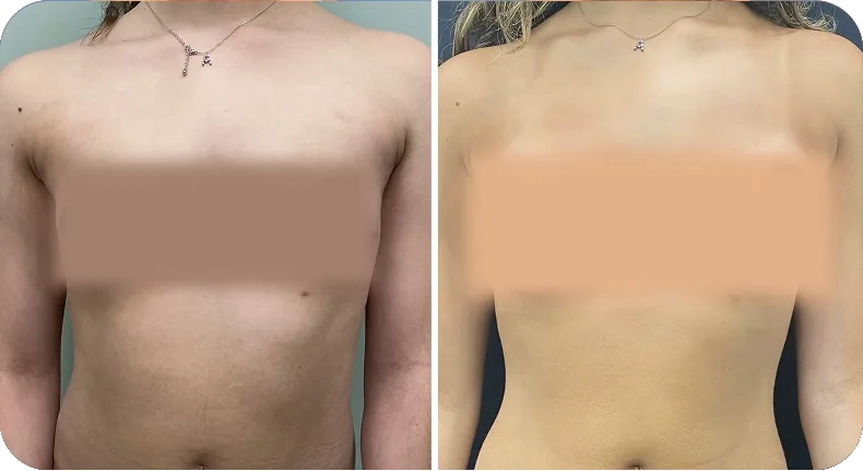 Before and after breast augmentation comparison with privacy protection markers
