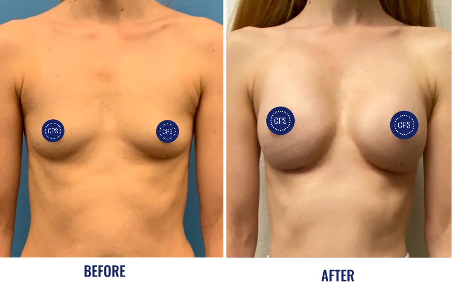 Before and after breast augmentation with labeled results and CPS badges