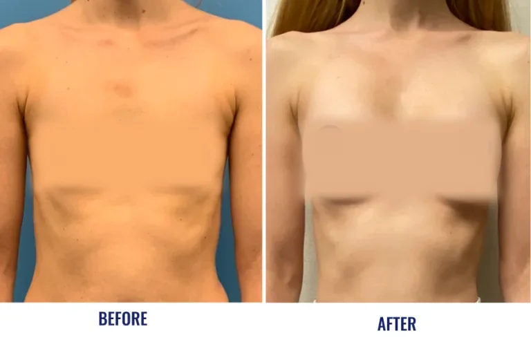 Before and after breast augmentation with labeled results and CPS badges