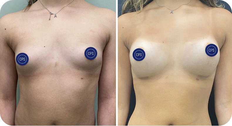Before and after breast augmentation comparison with privacy protection markers