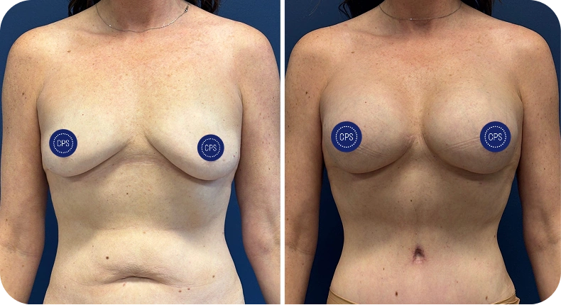 Before and after breast augmentation comparison with privacy protection markers