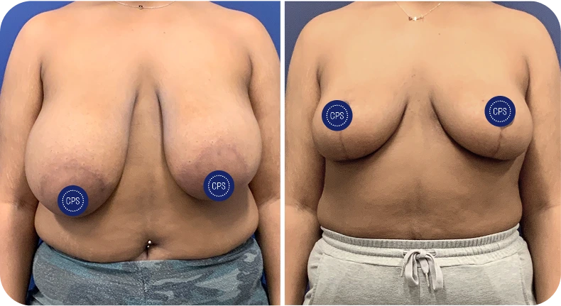 Before and after breast lift and reduction surgery results