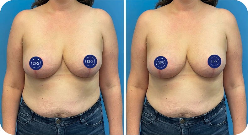 Before and after breast lift showing improved contour and nipple positioning