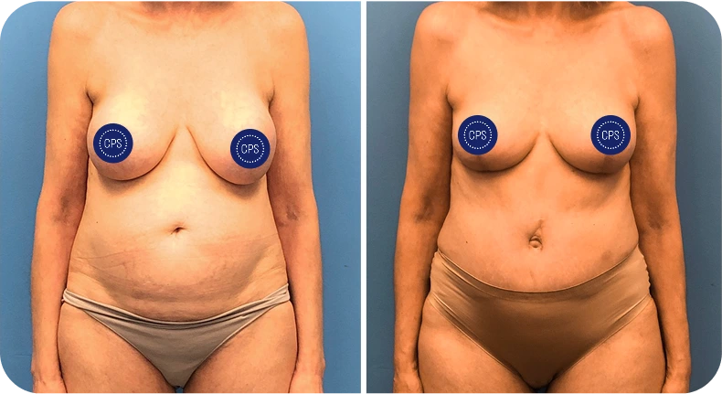 Before and after breast lift and reduction surgery showing improved shape and position