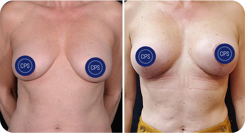 Breast lift and reduction before and after comparison with CPS logo