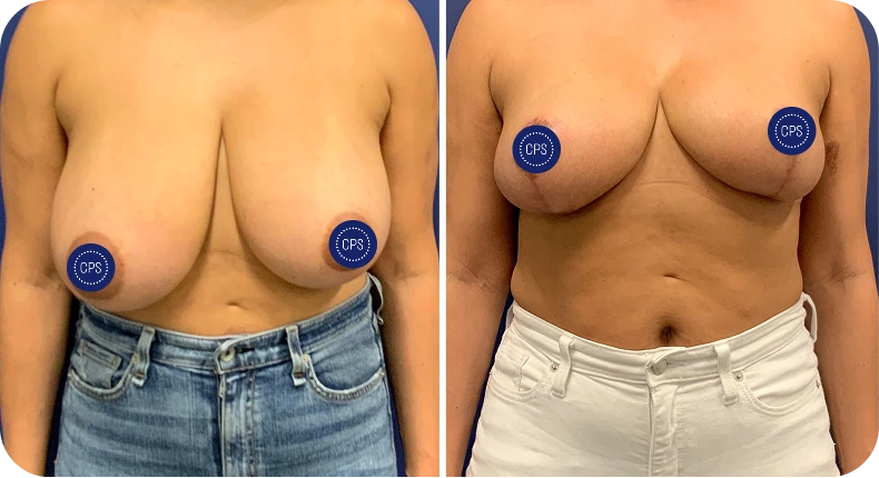 Before and after breast lift and reduction results showing improved symmetry and shape