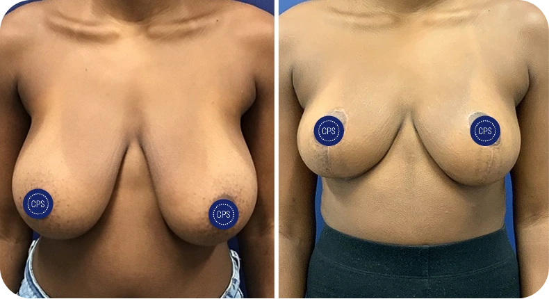 Before and after breast lift and reduction results showing reduced volume and lifted appearance