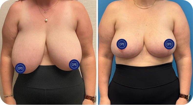Before and after breast lift and reduction with enhanced shape and lifted appearance