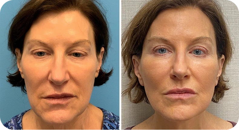 Before and after facelift comparison