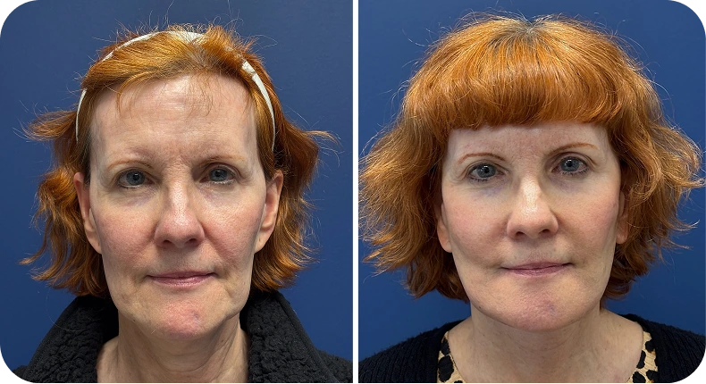 Before and after facelift comparison