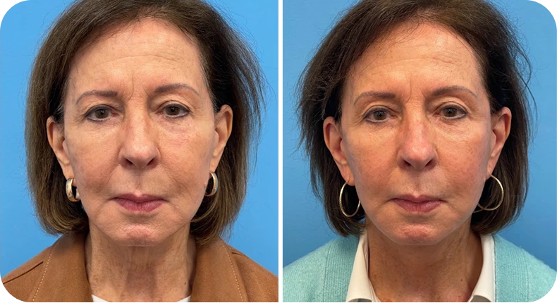 Before and after facelift comparison