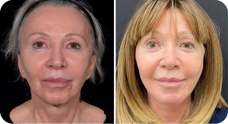Before and after facelift comparison