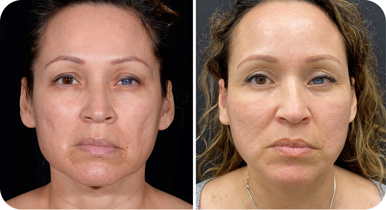 Before and after facelift comparison
