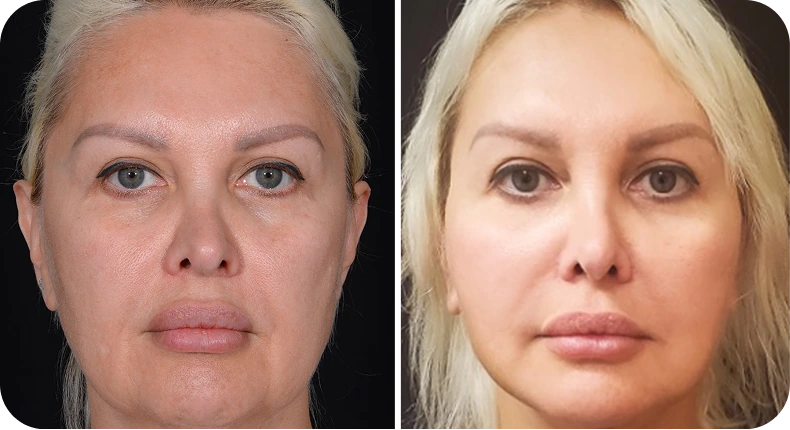 Before and after facelift comparison