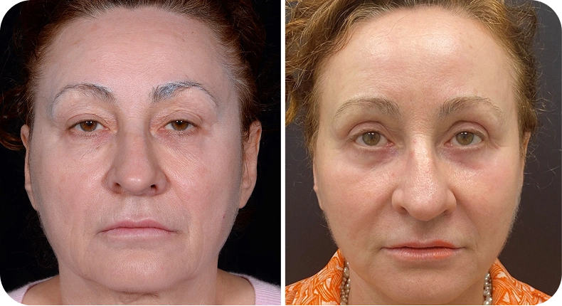 Before and after facelift comparison