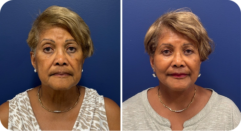 Before and after facelift comparison