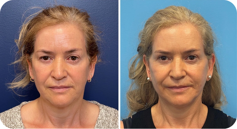 Before and after facelift comparison