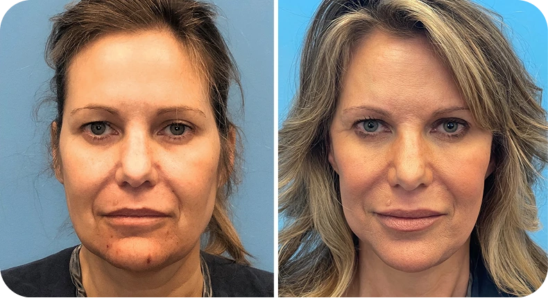 Before and after facelift comparison