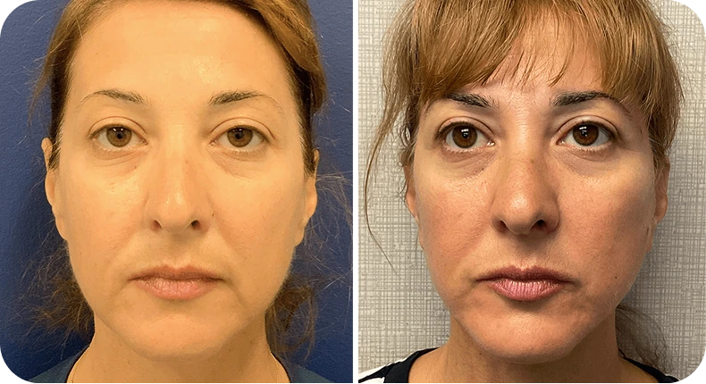 Before and after facelift comparison