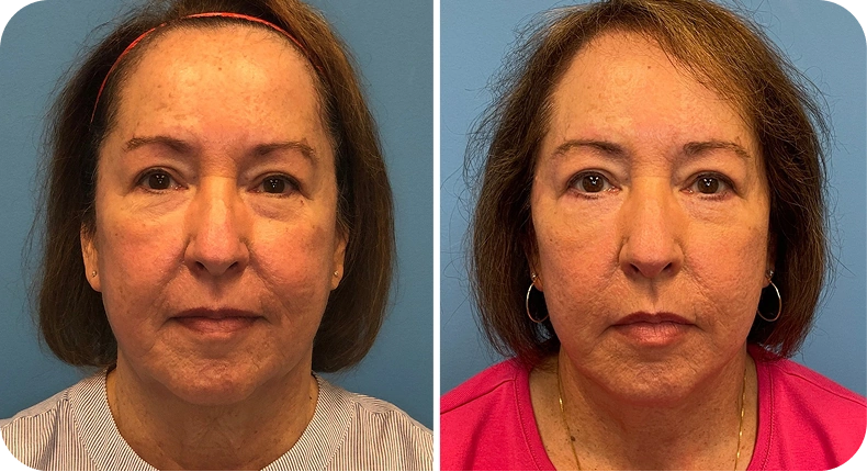 Before and after facelift comparison