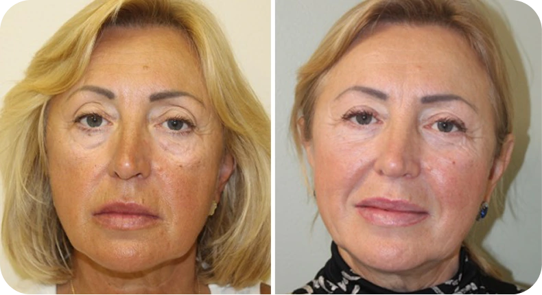 Before and after facelift comparison