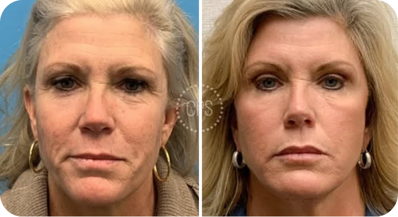 Before and after facelift comparison