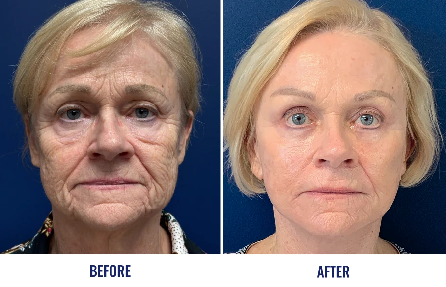 Before and after facelift results
