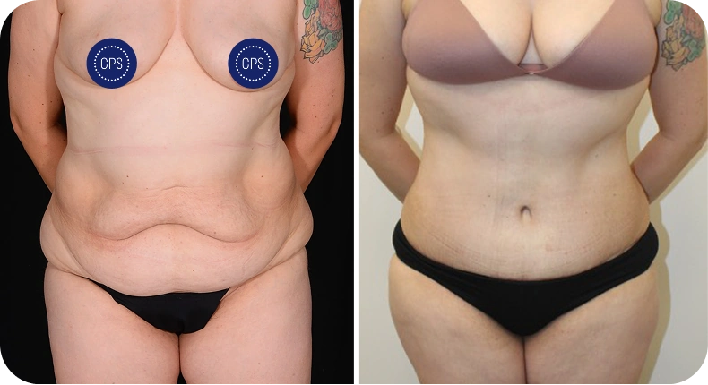 Before and after liposuction comparison