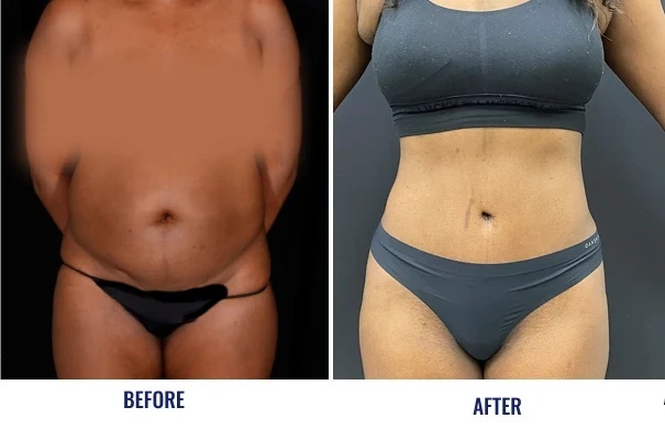 Before and after liposuction results