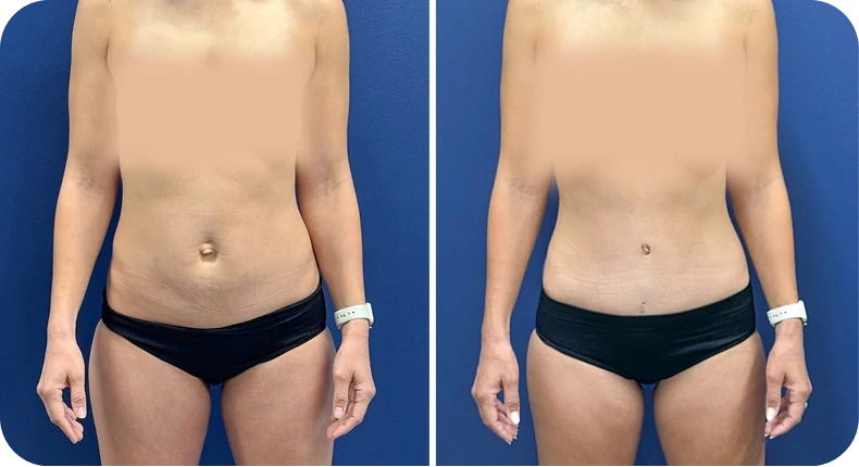 Before and after liposuction comparison