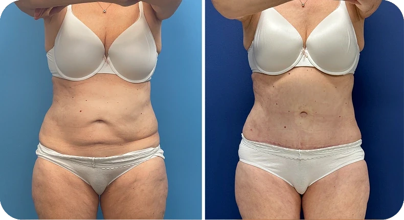 Before and after liposuction comparison