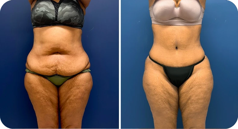 Before and after liposuction comparison
