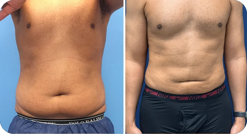 Before and after liposuction comparison