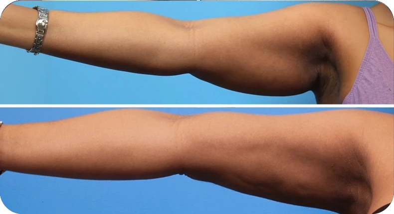 Before and after liposuction comparison