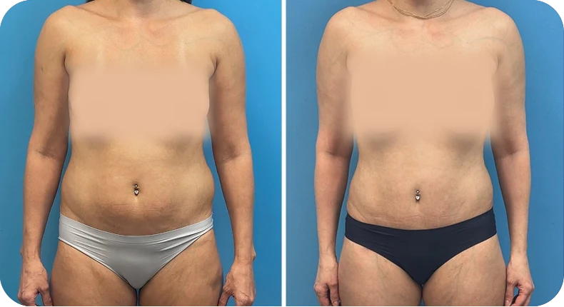 Before and after liposuction comparison