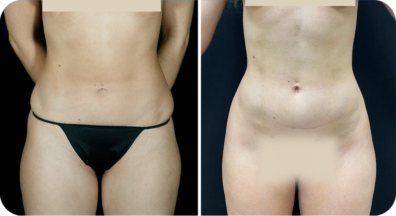 Before and after liposuction comparison