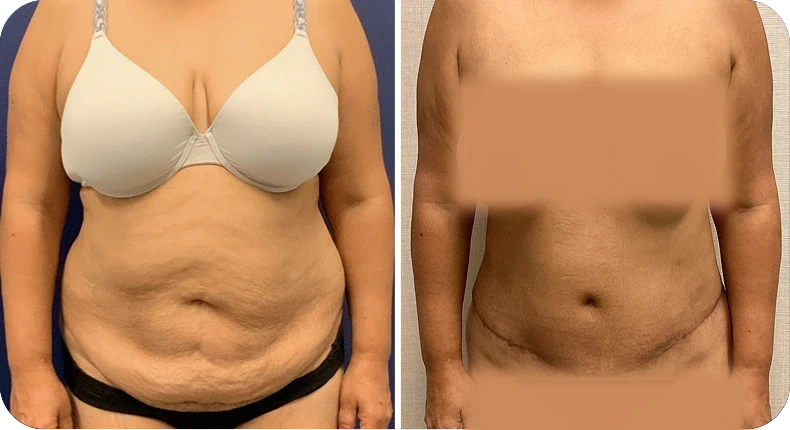 Before and after liposuction comparison