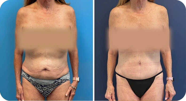 Before and after liposuction comparison