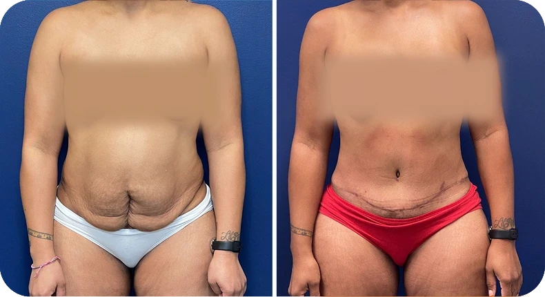 Before and after liposuction comparison