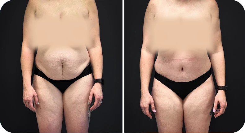 Before and after liposuction comparison
