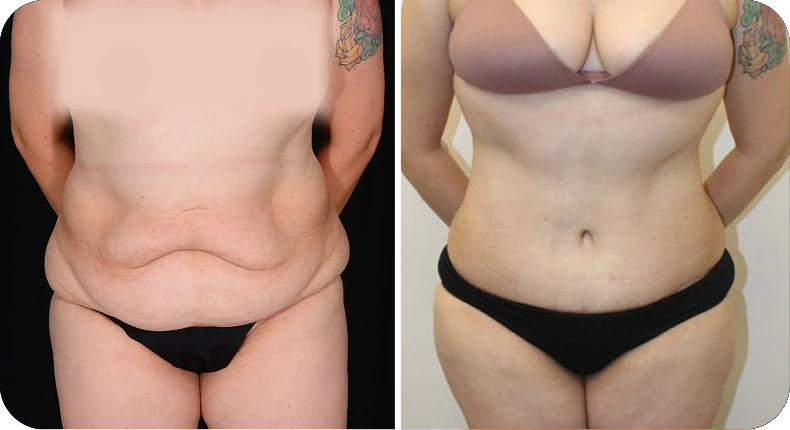 Before and after liposuction comparison