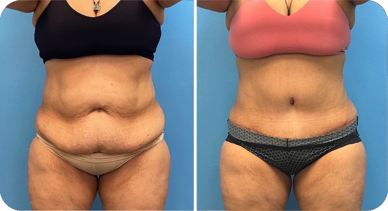 Before and after liposuction comparison