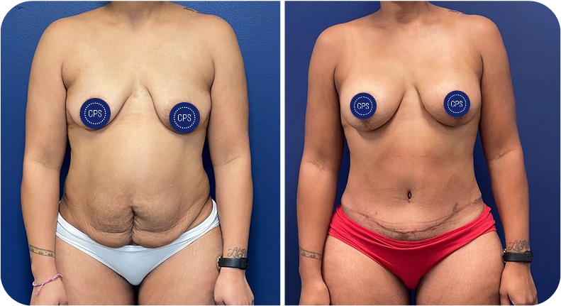 Before and after mommy makeover comparison