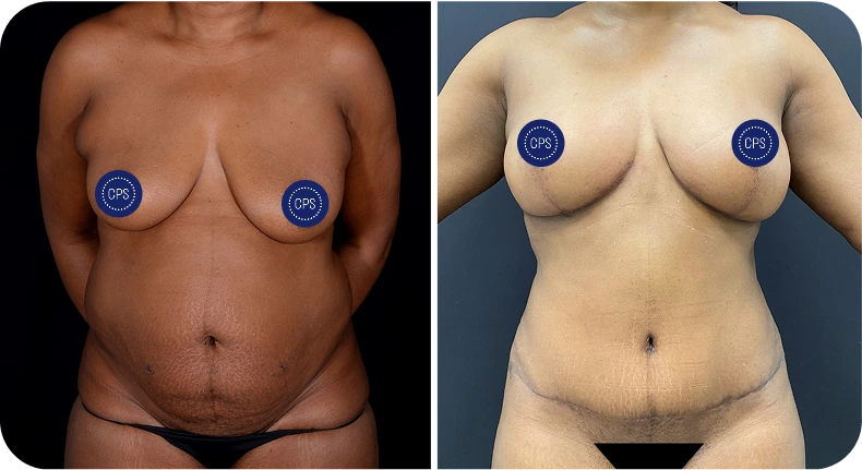 Before and after mommy makeover comparison