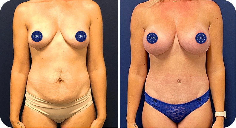 Before and after mommy makeover comparison