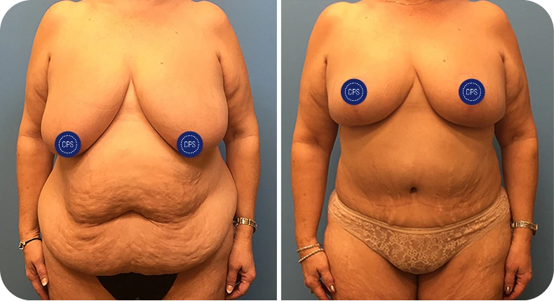 Before and after mommy makeover comparison