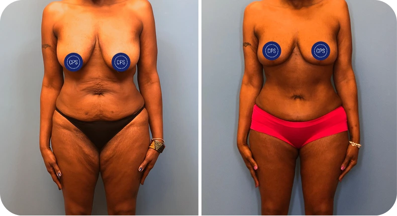 Before and after mommy makeover comparison